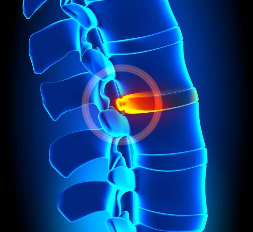 Bulging Disc Treatments To Give You Relief CureBackPain