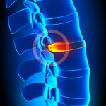 Bulging Disc Treatments To Give You Relief